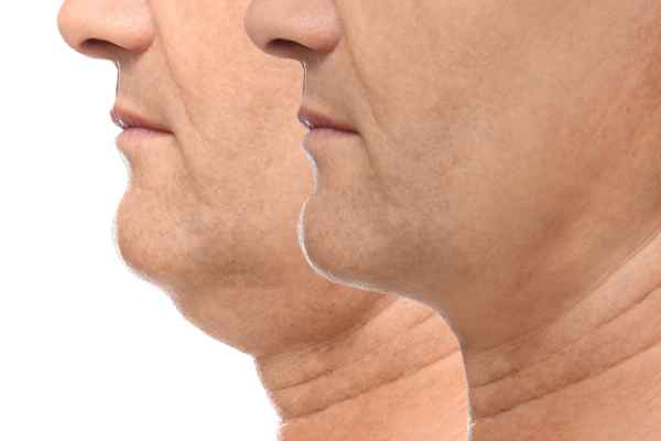 HIFU - Breakthrough in Anti - ageing 2 hifu results Borehamwood