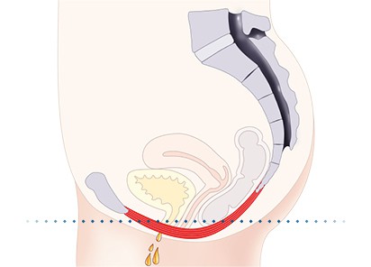 Pelvic-Floor Muscle Repair 5 Pelvic floor muscles Borehamwood