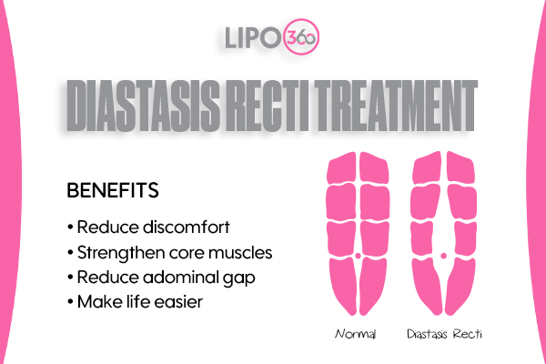 Revolutionising Muscle Repair: The Power of LIPO360 Body Sculpt Post-Injury 5 diastasis recti treatment Borehamwood