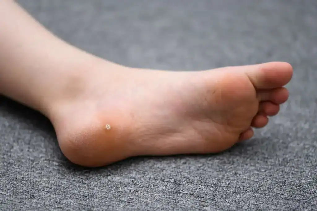 Cryotherapy For Warts And Also Verrucas 2 Image of verruca on the bottom of the foot that able to be treated with Cryotherapy Borehamwood
