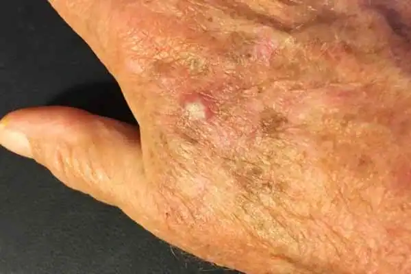 Image of Actinic keratoses Borehamwood on a person hand