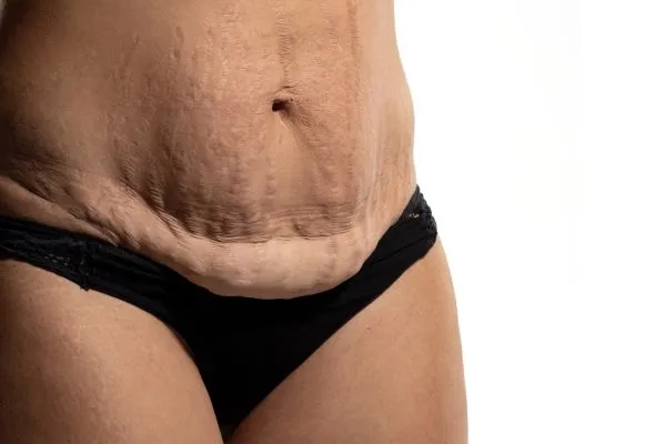 The science behind skin tightening Borehamwood picture of a woman's sagging skin on the stomach